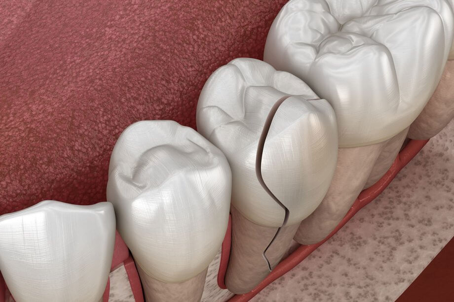 5 Signs You Cracked a Tooth