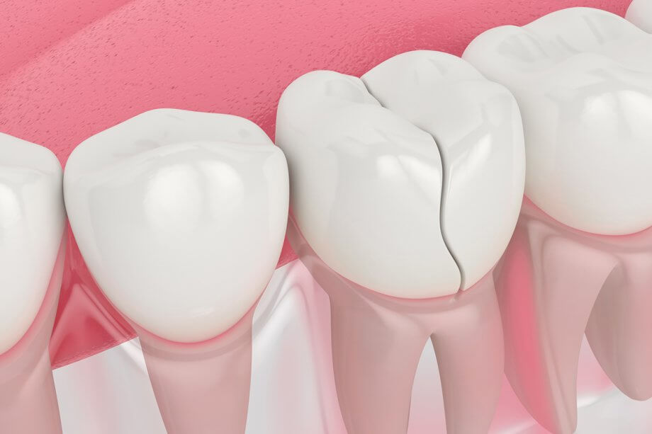 How Does An Endodontist Repair A Cracked Tooth?